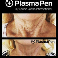 PlasmaPen-hoito