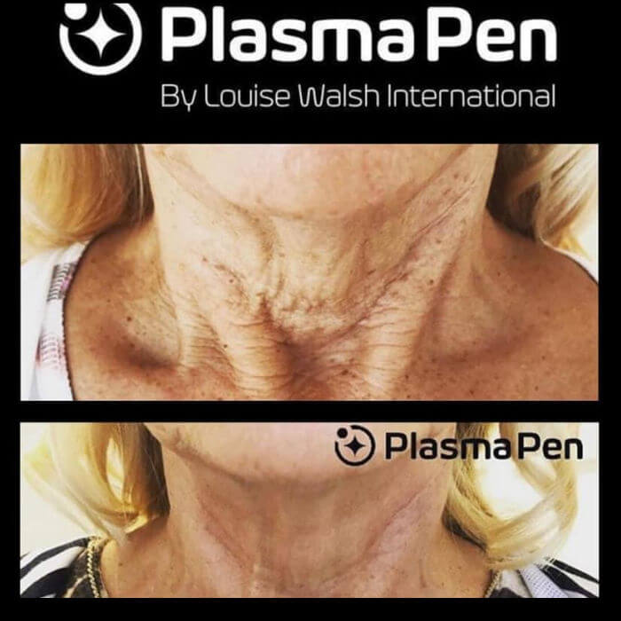 PlasmaPen-hoito