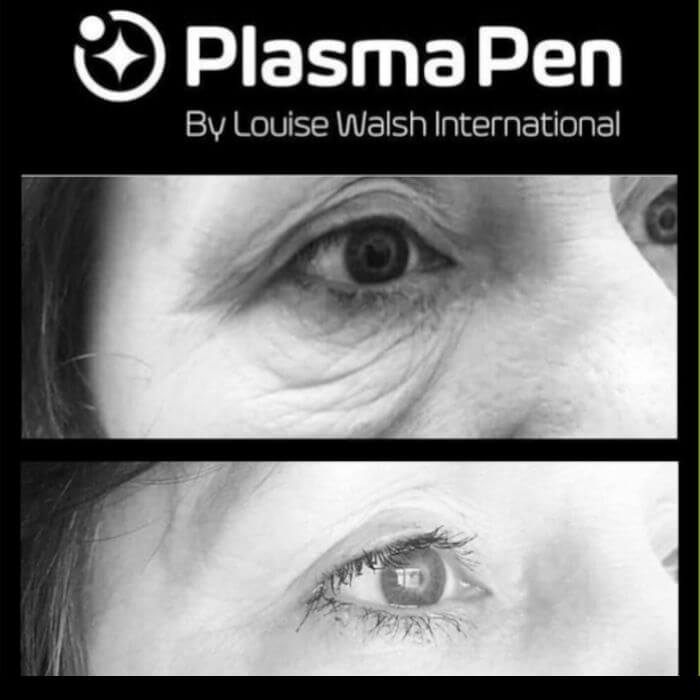 PlasmaPen-hoito
